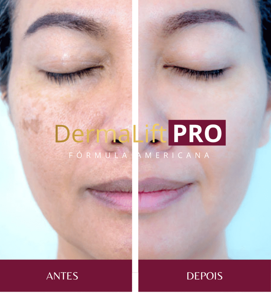 dermaliftpro